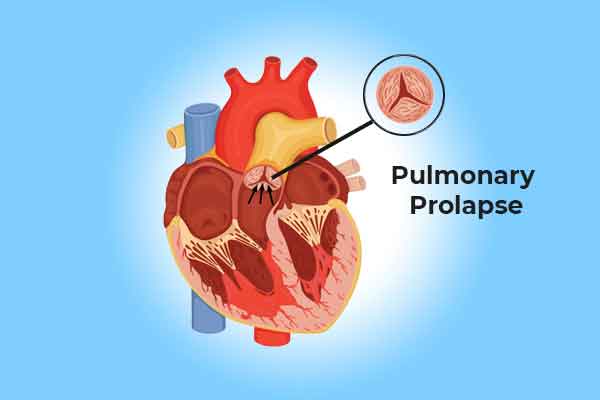 PULMONARY REGURGITATION